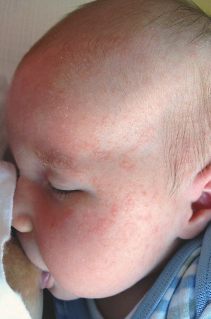 Schmerzhaft und unangenehm: beginnende Neurodermitis beim Säugling